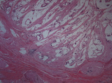 Infiltration of the bladder mucosa by mucinous adenocarcinoma. ...