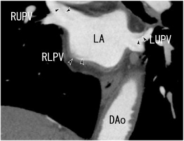 A 64-slice multidetector CT (64-MDCT) scan showed coronal images of thrombi in ...
