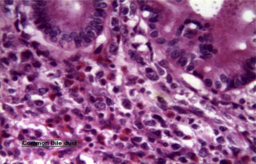 Histopathology of the common bile duct showing proliferating lymphocytes of ...