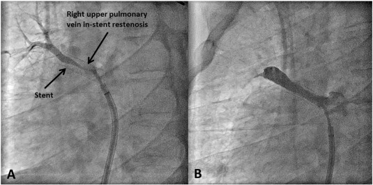 Right upper pulmonary vein stenosis requiring multiple interventions. (A) ...