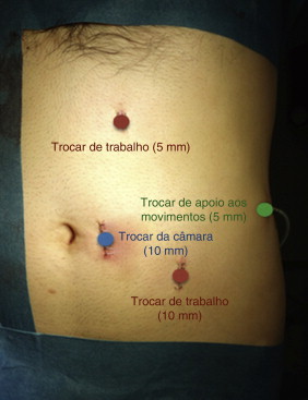 Posicionamento dos trocares.