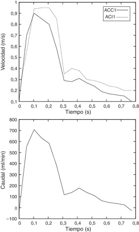 Caso clínico. Izquierda: velocidad en el eje de entrada en la carótida común ...