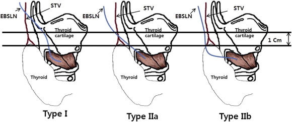Cernea classification of the EBSLN. In type I, the EBSLN crosses the superior ...