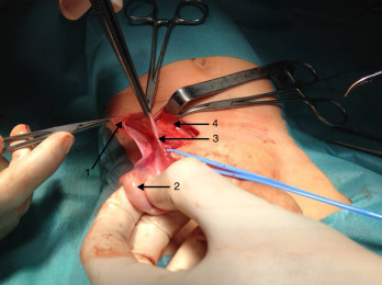 1) Saco herniário; 2) testículo; 3) cordão espermático; 4) músculo reto ...
