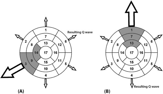 Pathogenesis of Q waves in HCM patients. Based on our results, abnormal Q waves ...