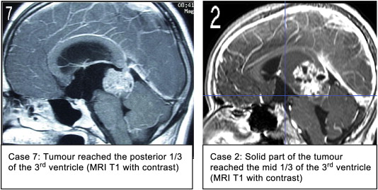 MRI images of the tumor location with respect to the third ventricle.