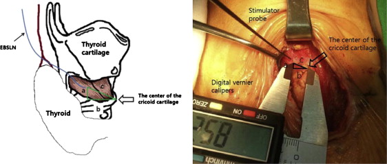 Anatomic distances from the center of the cricoid cartilage to the distal ...