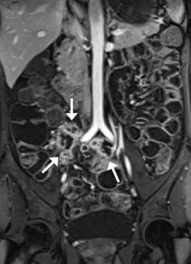 A 35-year-old man. Coronal postcontrast VIBE image shows multiple mesenteric ...