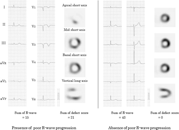 Electrocardiogram and SPECT images in cases of the presence or absence of poor ...