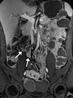A 36-year-old man. Coronal postcontrast VIBE image shows several enhancing ...