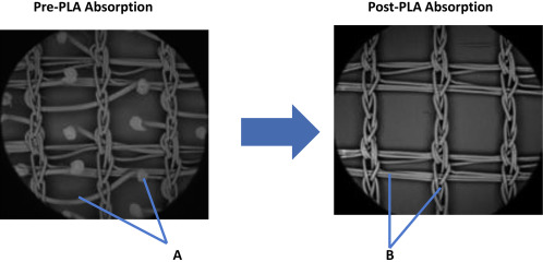 Parietex ProGrip mesh pre- and post- polylactic acid (PLA) absorption. (A) ...