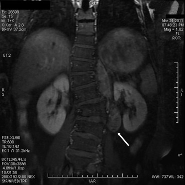 Magnetic resonance imaging reveals a left paravertebral soft-tissue mass, which ...