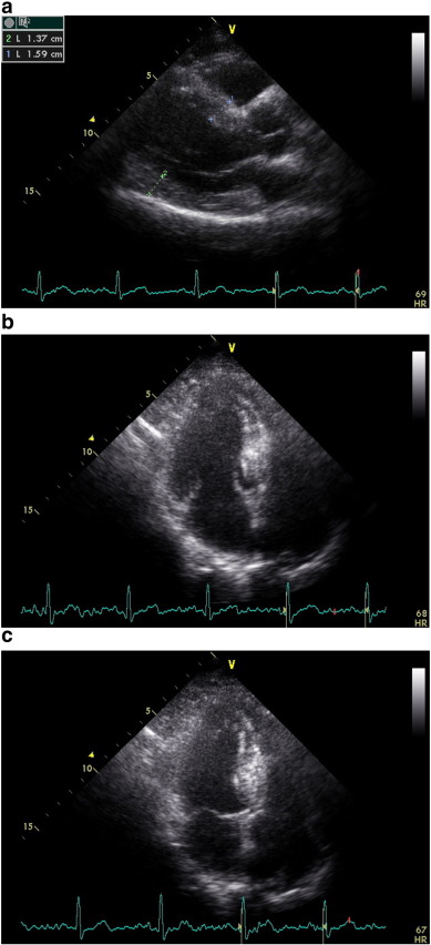 a, b, c: End-diastolic parasternal long-axis view, apical LV cavity geometry ...