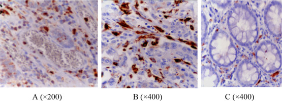 Immunohistochemical expression of IL23p19 in the ulcerative colitis groups shows ...