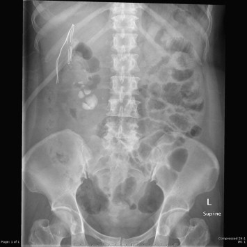 Residual stone at lower moiety after percutaneous nephrolithotomy.