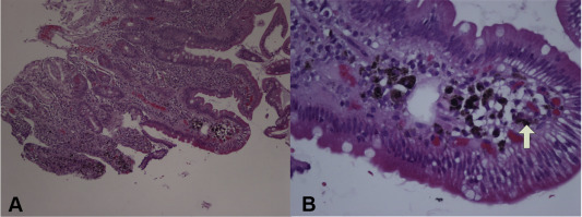 Histological examination revealed pigmented granules within the lamina propria ...