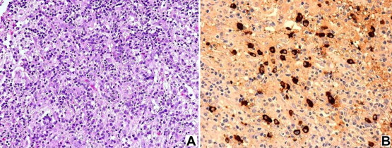 (A) Specimen mainly consisting of neurohypophysial tissue by lymphocytes, plasma ...