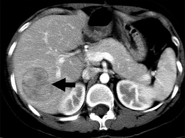 Computed tomography showed a hypervascular mass, 47mm in size, over segment 7 of ...