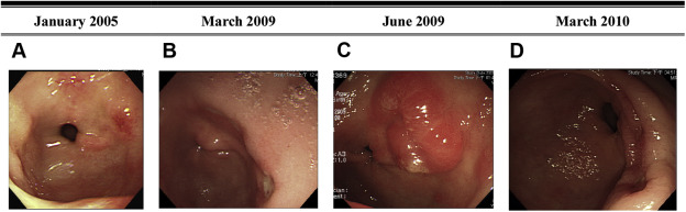 Case 6. A 68-year-old man underwent regular follow-up EGDs for GU since January ...