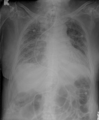 A standard 12-Fr flexible nasoenteral feeding tube is successfully placed into ...