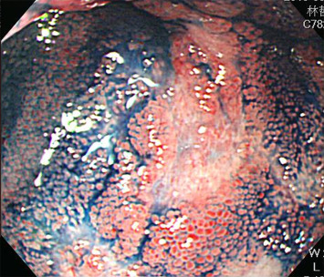 Chromoendoscopy with 0.2% indigo carmine dye demonstrates edematous hyperemic ...