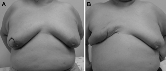 Case 2: (A) preoperative photograph; (B) photograph taken 4 months after the ...