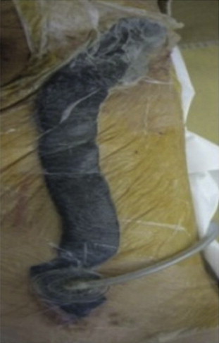 The GranuFoam dressing in the femoral wound is connected to that in the ...
