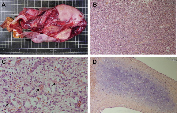 (A) Resected specimen under microscope, (B) area of embryonal sarcoma composed ...