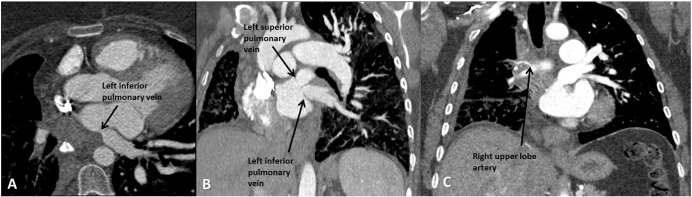 Extensive involvement of fibrosing mediastinitis. (A) Transverse section of ...