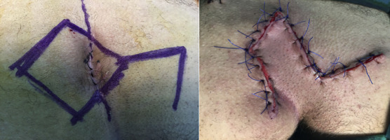 After modified Limberg flap reconstruction.