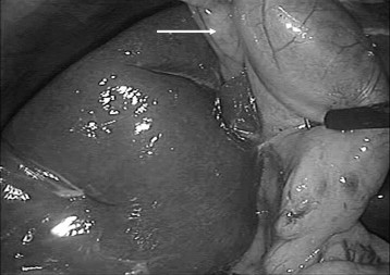 Gallbladder lying to the left of the falciform ligament (white arrow) in ...