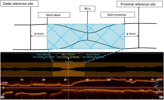 Schematic methods for OCT measurement of target lesion.