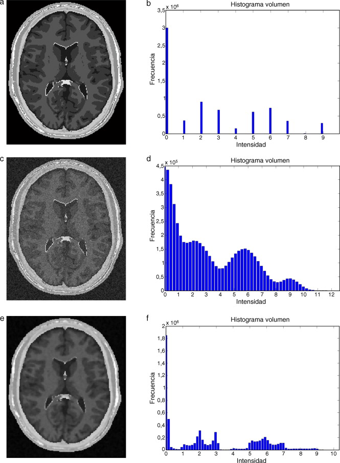 Aplicación de filtros en imagen phantom de IRM corrompida con ruido gaussiano. ...