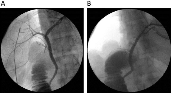 (A) Initial intraoperative cholangiography shows trifurcation of bile duct. (B) ...
