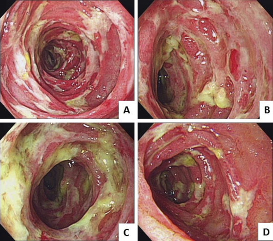 (A–D) Single-balloon enteroscopy shows diffuse irregularly shaped ulcers with ...
