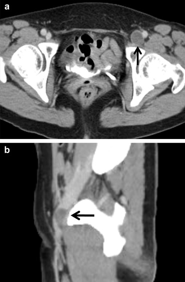 Contrast-enhanced computed tomography demonstrating distension of the left ...