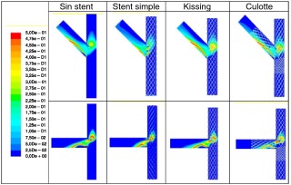Índice OSI (oscillatory shear index) para las diferentes configuraciones.