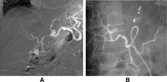 Hepatic artery angiography for Case 3. (A) Pseudoaneurysm at the anastomotic ...