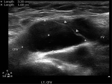 Ultrasound longitudinal scan showing the presence of a 3.2 cm × 1.7 cm, ...