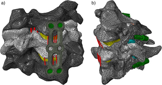 a) Fusão cervical anterior; b) fusão cervical posterior.