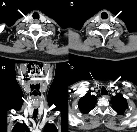 Enlarged parathyroid glands in computed tomography. (A) Right superior ...