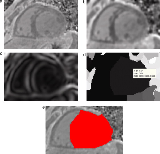 Preproceso y segmentación el volumen del ventrículo izquierdo. (a) Corte axial ...