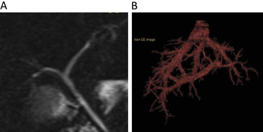 Preoperative graft image. (A) Trifurcation of the bile duct and (B) hepatic ...