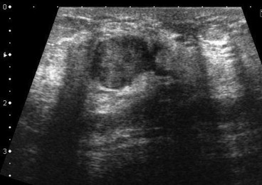 Ultrasonography revealed a solid tumor beneath the left areola with a dilated ...
