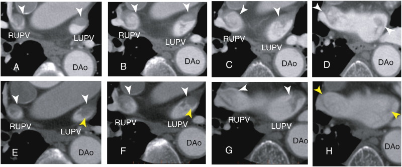 Axial images showing thrombi within the right upper and the left upper pulmonary ...