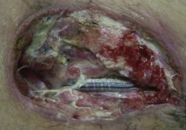 Macroscopically visible poor granulation and signs of infection observed on the ...