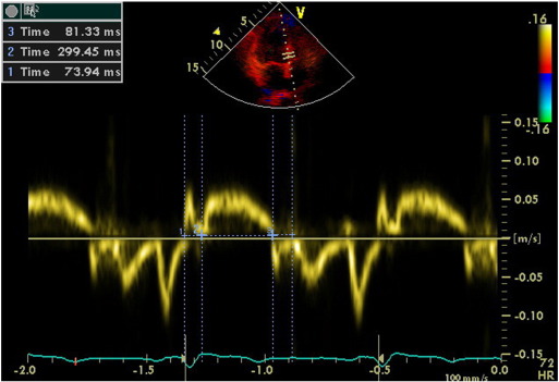 Evaluation of isovolumetric contraction time, contraction time and isovolumetric ...