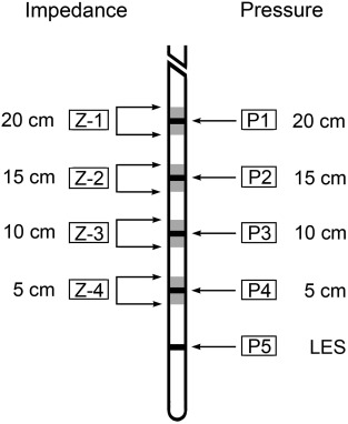Nine-channel combined multichannel intraluminal impedance and manometry ...