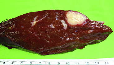 Pathological findings of the lesion. Gross pathologic specimen revealed a ...