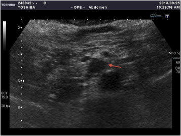 Transabdominal ultrasonogram demonstrated a hypoechoic mass (arrow) in the uncus ...